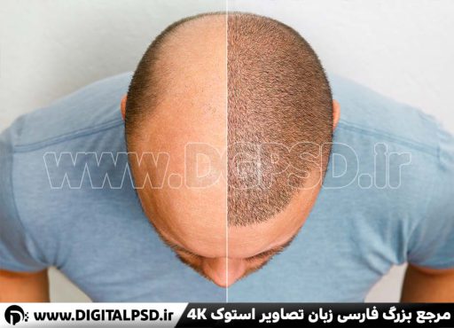 دانلود عکس با کیفیت قبل و بعد کاشت مو